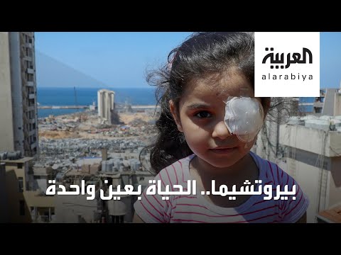 شاهد قصة مؤلمة لطفلة لبنانية فقدت إحدى عينيها بانفجار بيروت